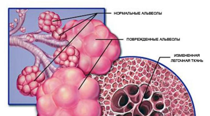 Терапия обострения хронической обструктивной болезни легких Чем опасно заболевание хобл